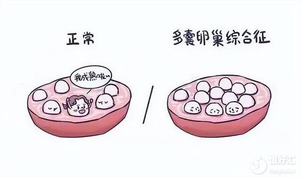 多囊卵巢想怀孕怀不上教你三招